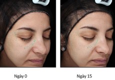 Giảm nếp nhăn sau 15 ngày và những điều bạn chưa biết